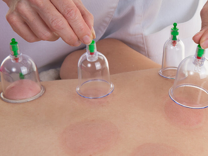cupping